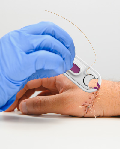 product in use to stitch hand injury